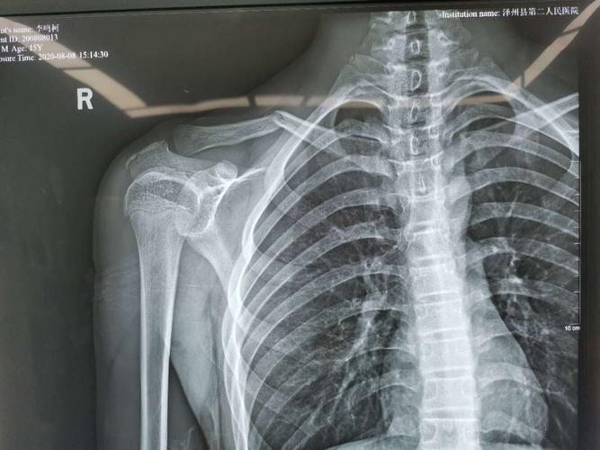 "小mi"治锁骨骨折