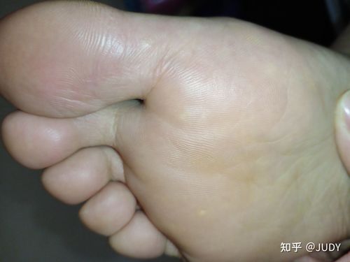 关于跖疣发现以及治疗的经历