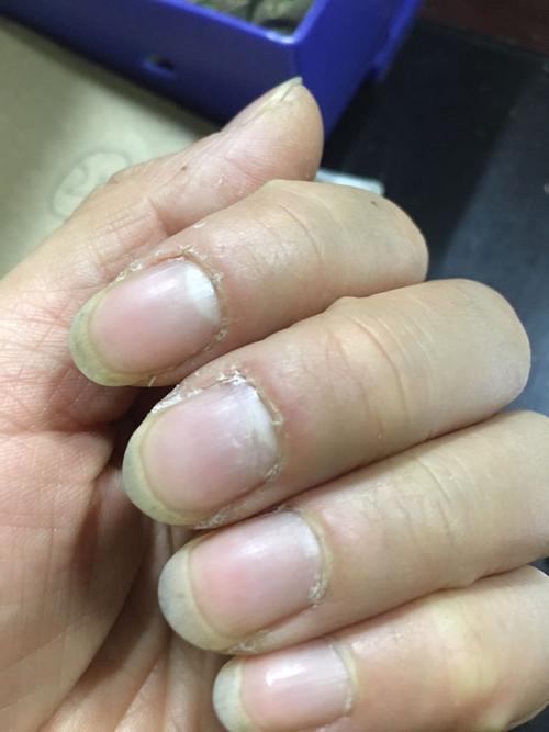 手指甲旁边的皮肤开裂还很硬怎么回事?