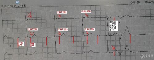 房性早搏后面可以跟个室早吗? - 心电图脑电图专业版