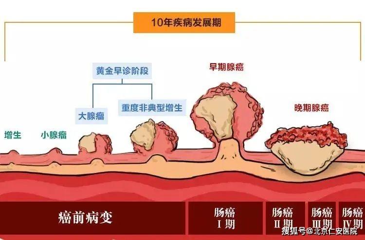 腺瘤性息可能与遗传,慢性炎症刺激,生活习惯,慢性便秘等因素有关.