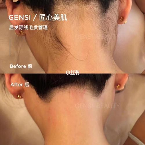 后发际线毛发管理95 更气质,显得脖子更长哦_痘坑_收缩毛孔_皮肤