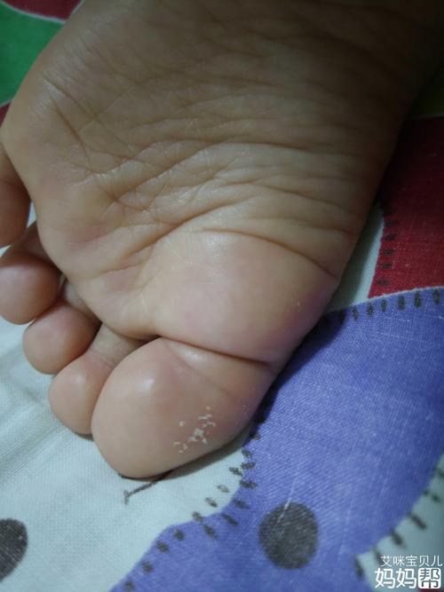 宝宝大脚趾有倒刺
