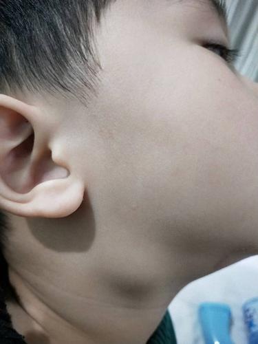 四岁半儿童淋巴结357215