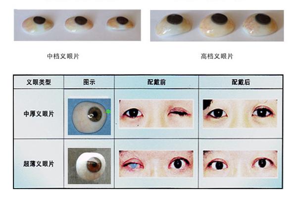 眼球摘除后如何装配义眼?