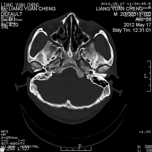 ct38674:鼻骨骨折吗?