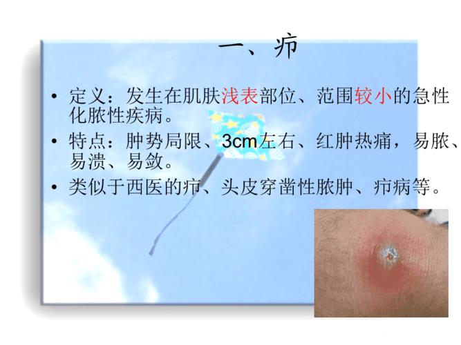 疮疡疖疔有头疽