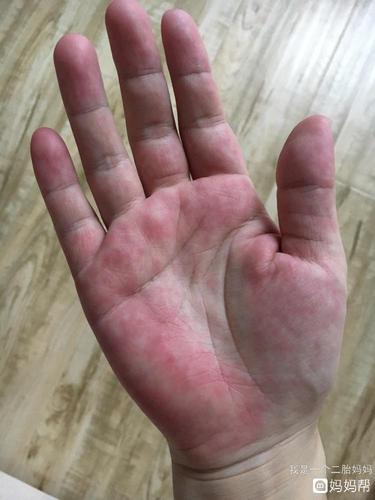 我孕期手掌一直这样红 掌心不红 有异常吗?
