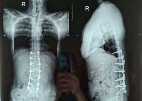 医院新闻脊柱外科专家妙手拉直折刀人