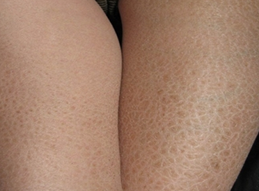 鱼鳞病还会引起哪些症状