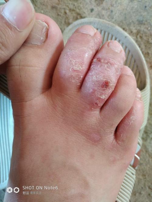 我的脚是怎么了,上面有很多小水泡,有时很痒,然后我就使劲抠,导致脚趾