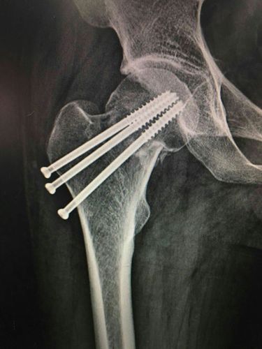 股骨颈骨折空心钉固定术后移位的讨论