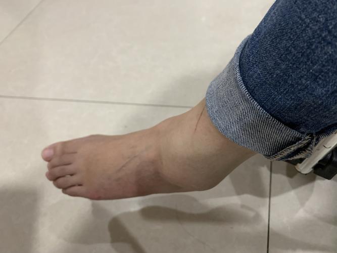 第一次崴脚都崴得这么严重_医疗健康_医疗健康其他