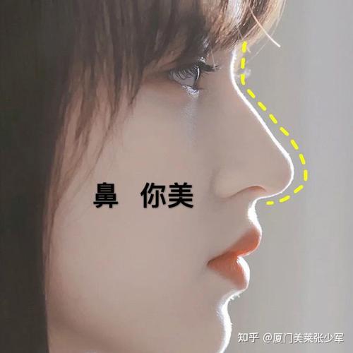 厦门隆鼻好看的鼻子不是高就够了形态好看才是重点