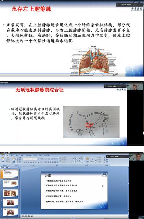 了小儿尸检时先原位观察胸腹腔脏器和心脏的重要性,先心病解剖注意