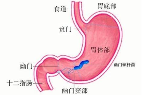 如何预防幽门梗阻?