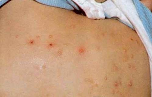 皮疹症状图片