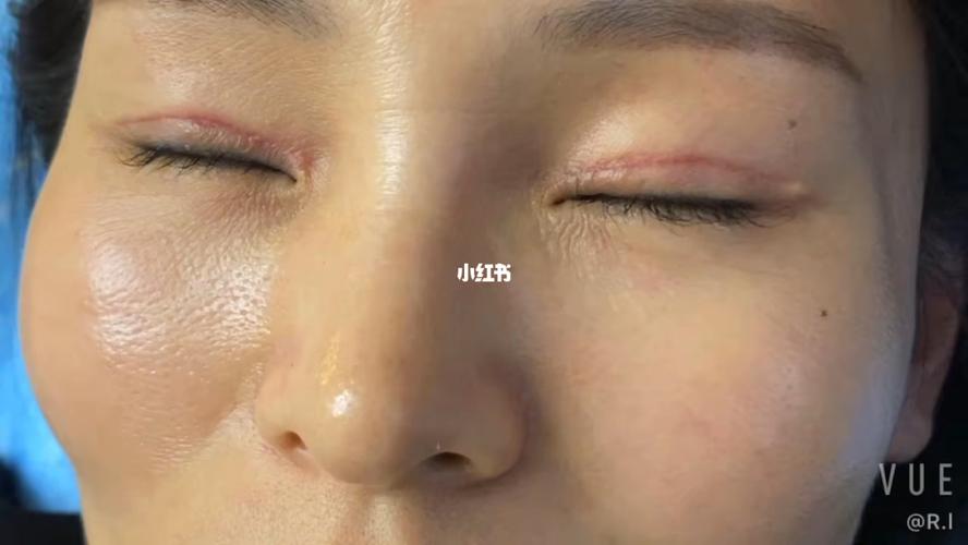 双眼皮增生_双眼皮_美妆_医美整形