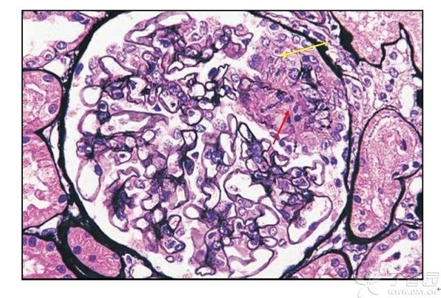 节段性病变:黑色箭头:肾小球毛细血管腔内透明血栓形成;红色箭头:系膜