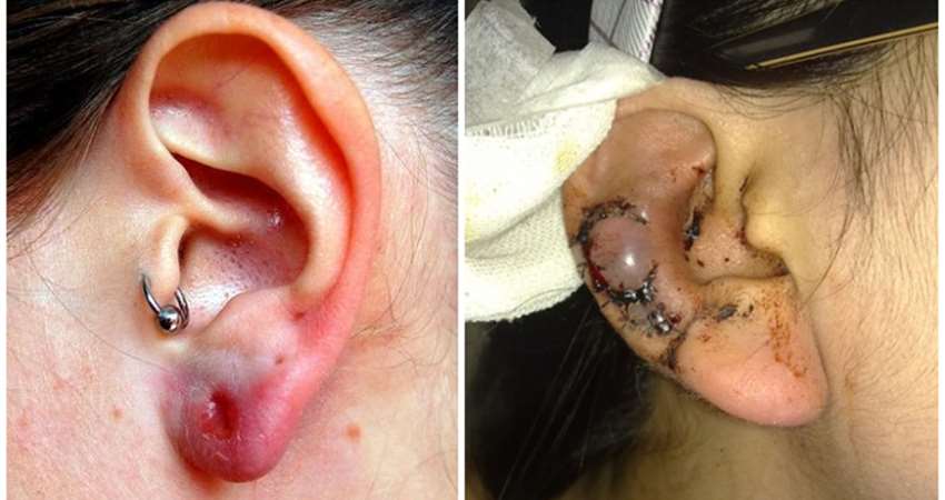 「耳洞」为什麼会红肿又变臭?答案真可怕!