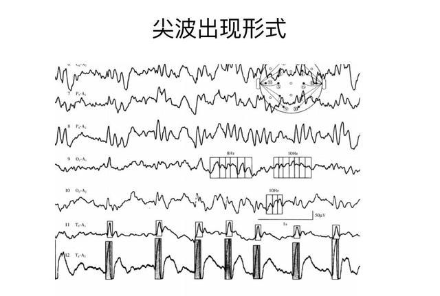 儿童脑电图基础与判读解析