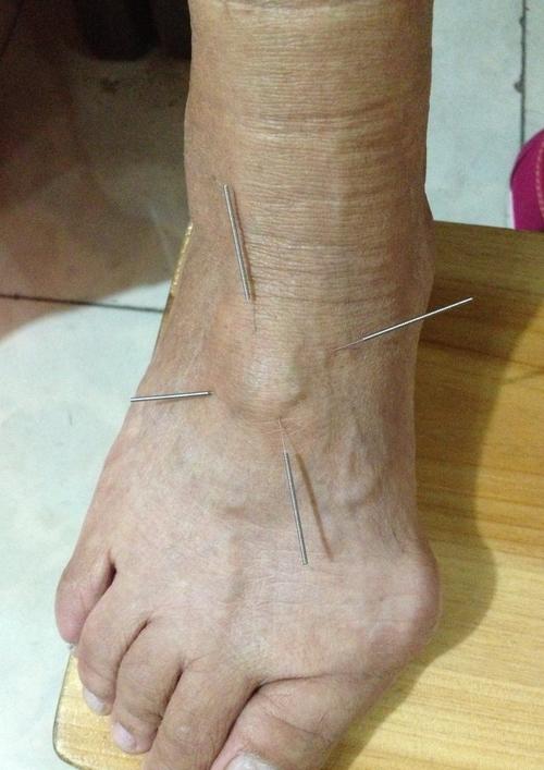 [转载]骨质增生