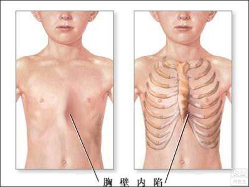 随着年龄的增加,症状变现会越来越明显,凹进去的胸部,吐出来的肚子