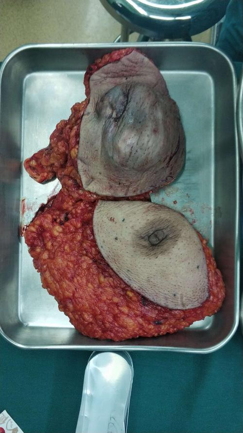 切除的乳房及腋窝包块
