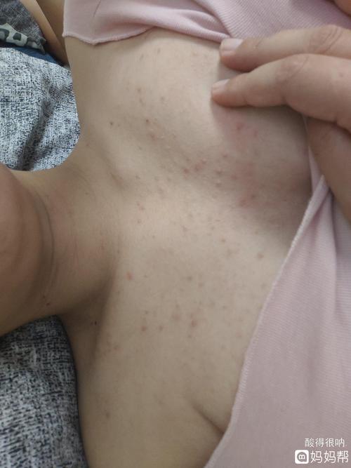 有没有怀孕期间胸前一直长痘痘的,还好不长