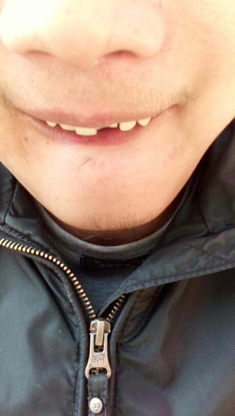 刚才不小心被撞掉了.半颗门牙.然后不通也