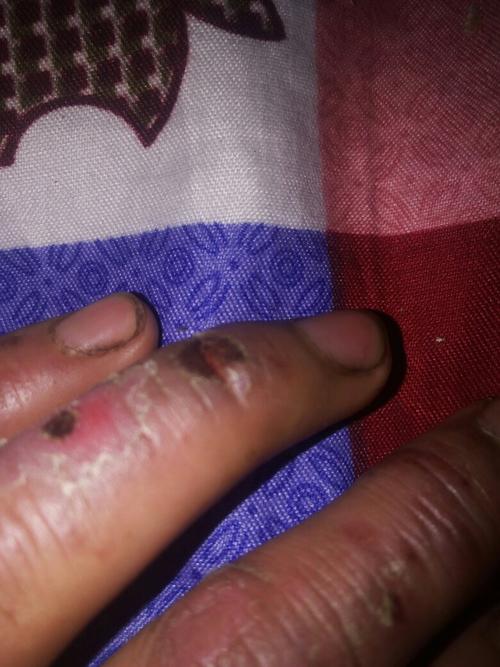 手上关节处冻疮裂开 怎样好的快啊 看看图片严重不 一干活就裂开扯的