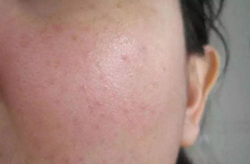 过敏一定是化妆品的错最全皮肤过敏处理方法收藏版