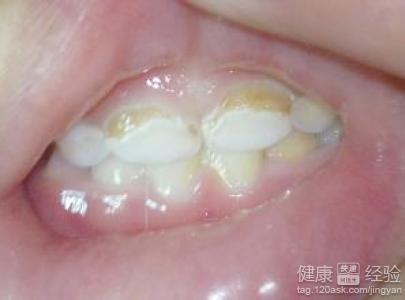 白喉是怎么引起的