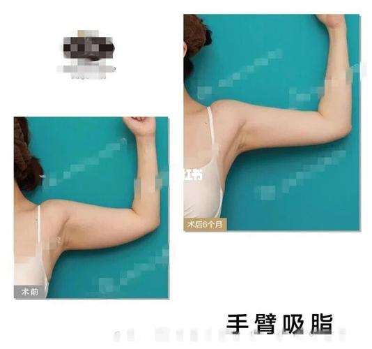 "拜拜肉"难受但并不难瘦!3招让你跟它说_肉毒素_吸脂