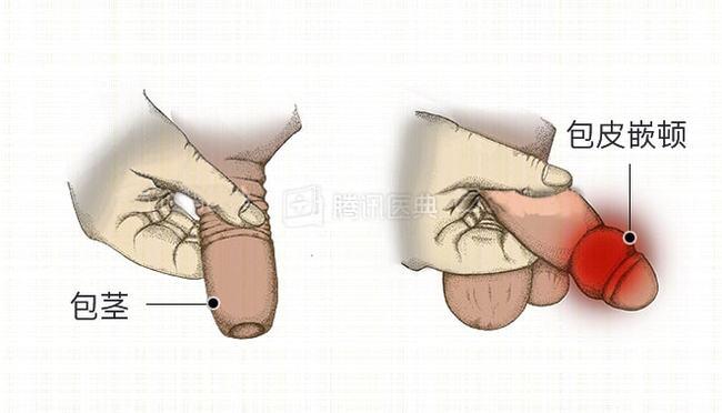同时,如果青春期仍存在包茎,阴茎被束缚,影响孩子阴茎发育,限制阴茎