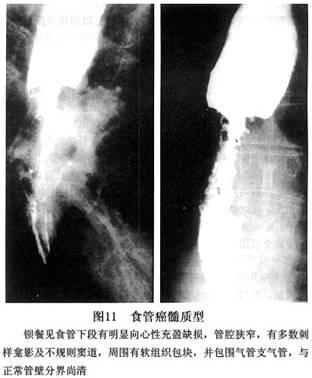 髓质型:病变显示为不规则的充盈缺损,有不同程度的管腔狭窄,病变的上