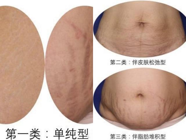 女人生完孩子以后肚子的"真实"状态是怎么样的?宝妈