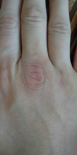 拳头和墙硬碰硬受伤1年未好,伤了软组织,该怎么样才能恢复?