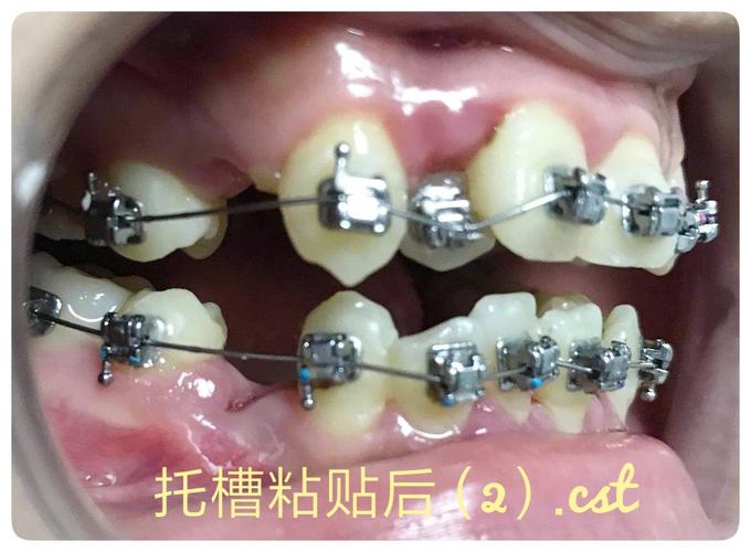 托槽粘贴后(2)