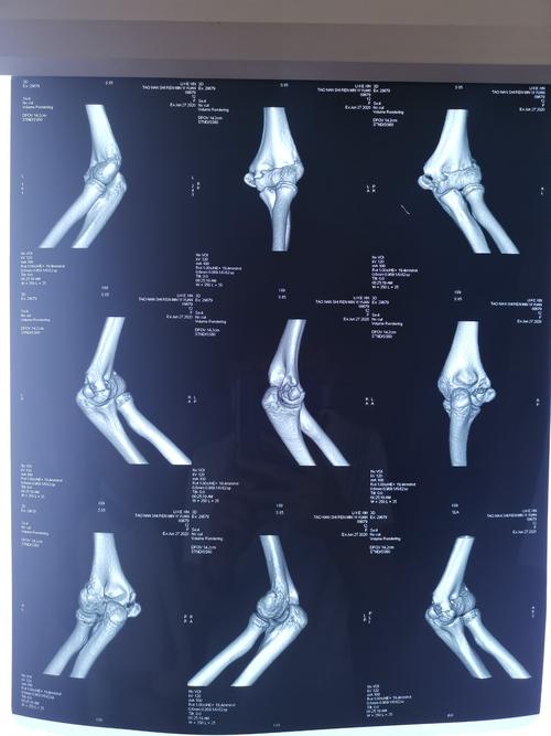 术后石膏固定35天,现患者左侧肘关节活动受限,关节活动度伸-屈:45-135