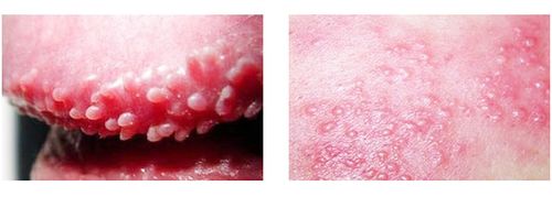 尖锐湿疣怎么传染的