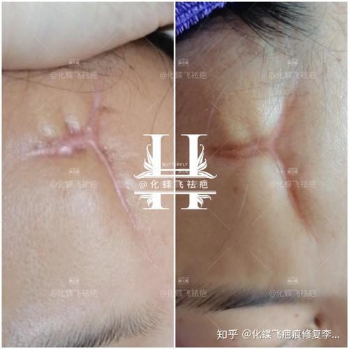 湖北疫情期间,意外受伤,疫情严重没办法去医院缝合,产生了复杂性疤痕.