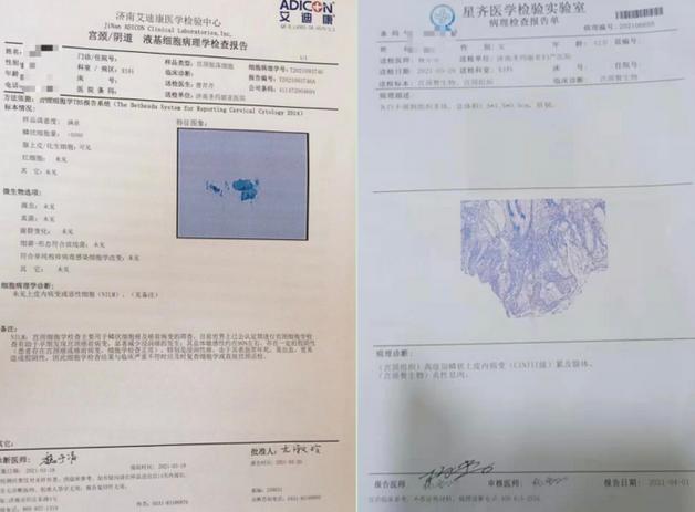 hpv,tct阴性也可能有问题