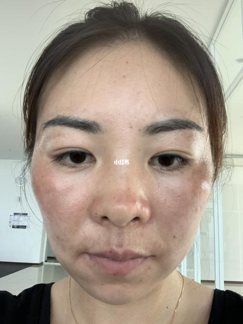 祛斑 黄褐斑 铅汞斑_祛斑_黄褐斑_护发_护发心得分享