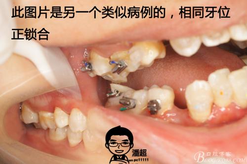 正锁合解除了,牙列也初步排齐,这里送上正锁合解除的,懒人办法