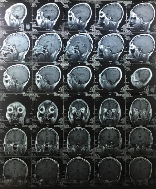 常见囊性变和出血坏死,有包膜,属脑外肿瘤