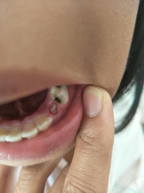 我家小孩的牙齿断了还剩一点牙根在里面,不知道影不影响长新牙?