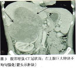 ct检查:右中上腹部巨大肿块,范围约14.0 cm×12.0 cm×22.