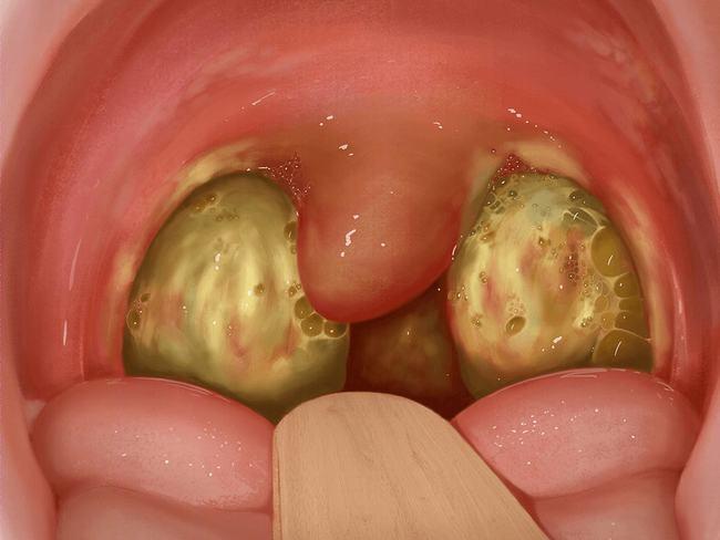 博海患教时间小儿化脓性扁桃体炎严重吗如何治疗和预防