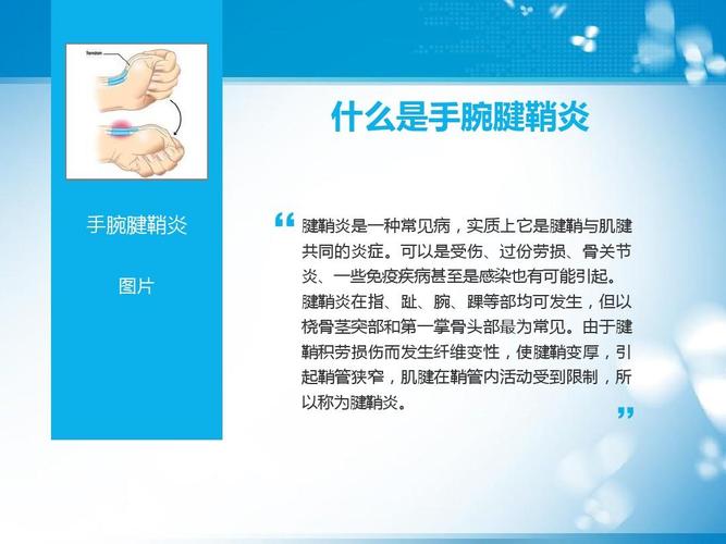 手腕腱鞘炎吃什么药